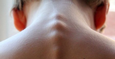 Cifosis dorsal, curbatura de la columna