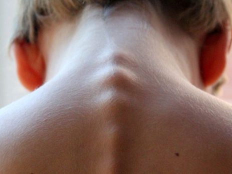 Cifosis dorsal, curbatura de la columna