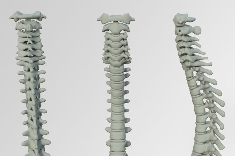 cifosis dorsal, curvatura de la columna