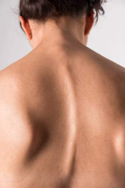 escoliosis