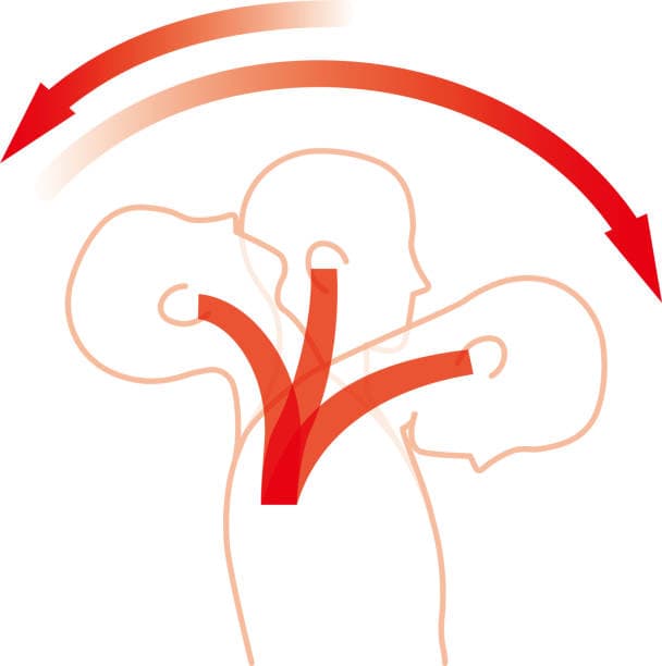 el esquince o latigazo cervical
