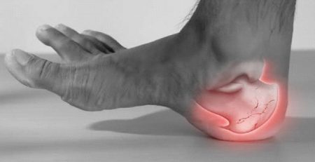 Fractura del calcáneo