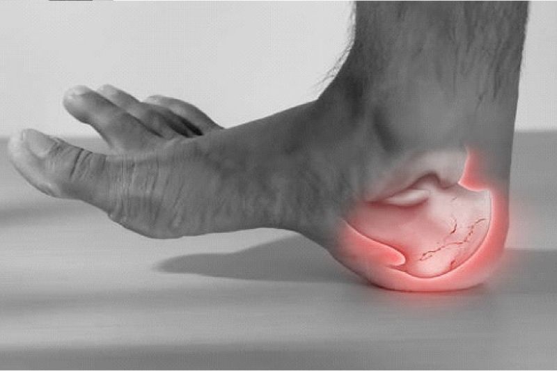 Fractura del calcáneo