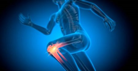 condromalacia rotuliana