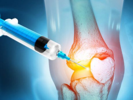 Inyección de ácido hialurónico en la rodilla para tratar el dolor articular.