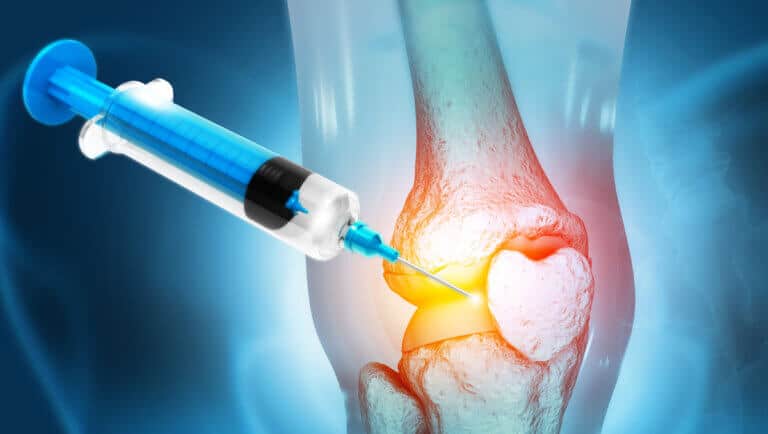 Inyección de ácido hialurónico en la rodilla para tratar el dolor articular.